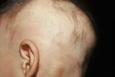 alopecia treatment Valencia