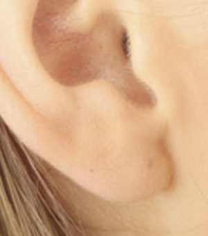 Reconstruction of ear lobes