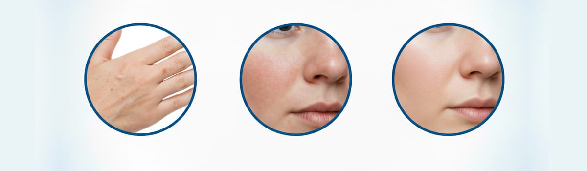 Head AFT Photorejuvenation Head AFT Photorejuvenation