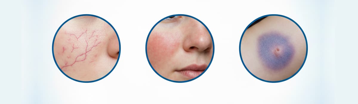 Vascular and Pigmented Head AFT Vascular and Pigmented Head AFT