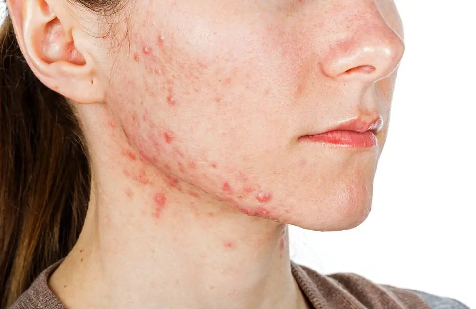 causas acne y tratamiento